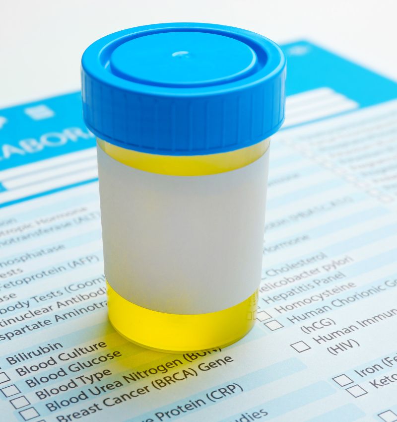 Urinalysis Sample